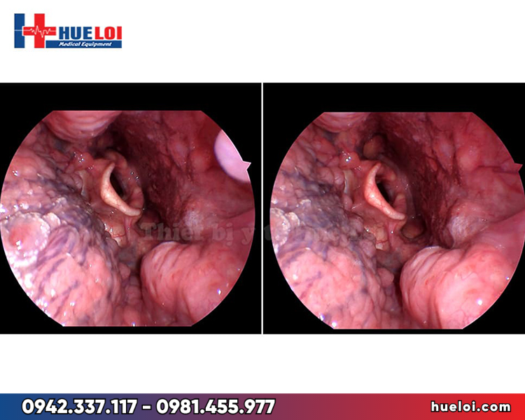 	Máy nội soi tai mũi họng xách tay Full HD - hình ảnh nội soi họng thu được