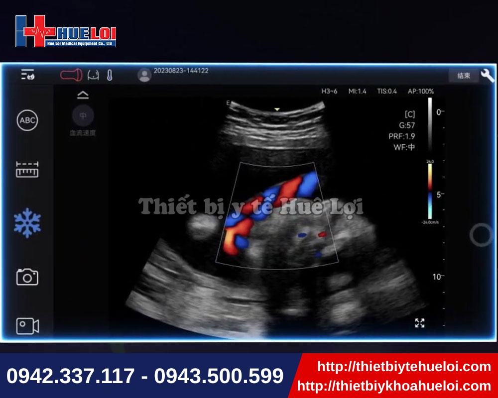 Máy siêu âm di động nhỏ gọn với chất lượng hình ảnh vượt trội