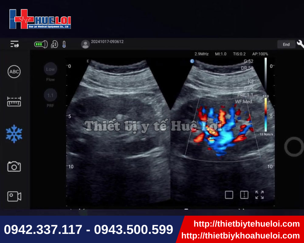 Chức năng chia đôi màn hình trên phần mềm máy siêu âm chẩn đoán cầm tay