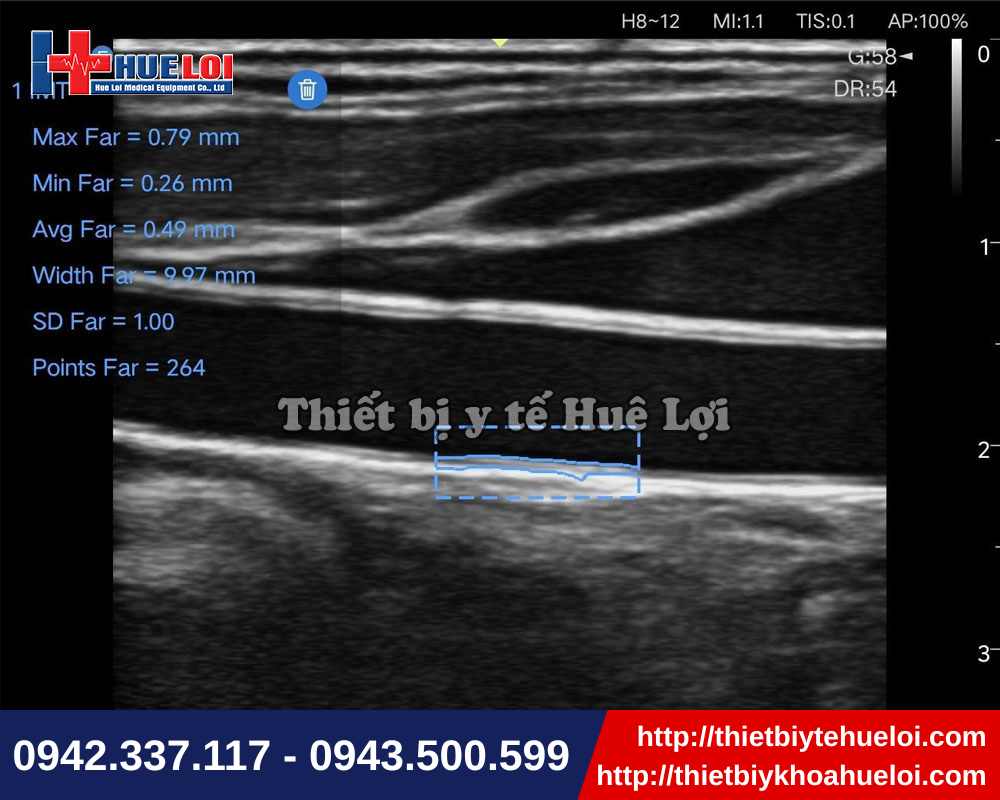 Máy siêu âm di động cho chất lượng hình ảnh sắc nét