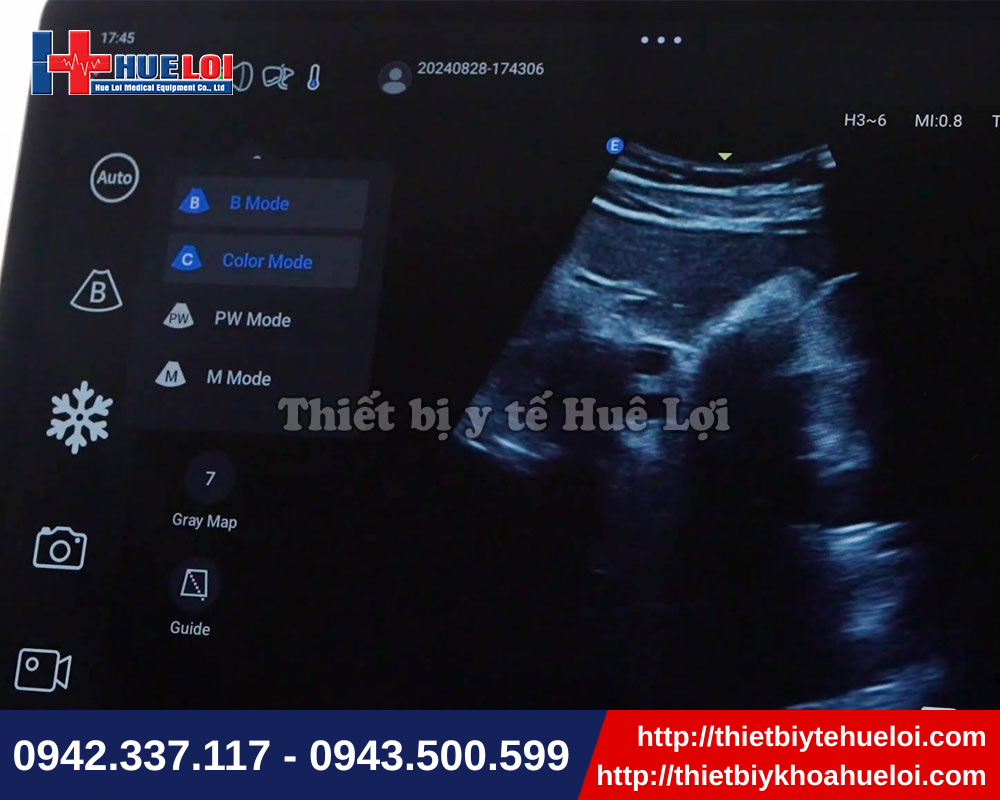 Hình ảnh hiển thị sắc nét với máy siêu âm chẩn đoán cầm tay