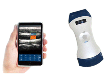 Máy Siêu Âm Không Dây