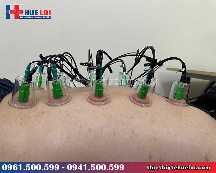 chế độ điện châm kết hợp giác hút máy điện châm không kim