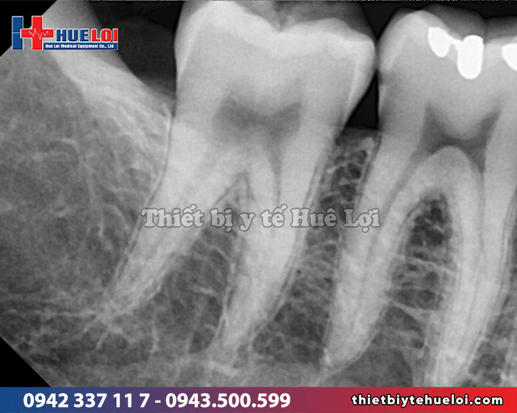 hình ảnh chụp x-quang răng