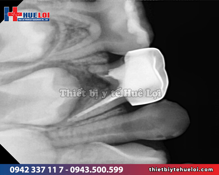 hình ảnh x-quang chẩn đoán răng