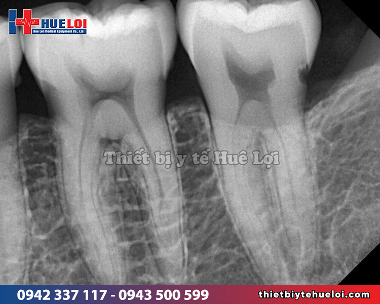 hình x-quang răng