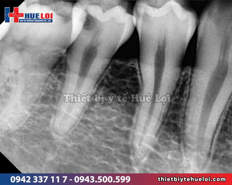 kết quả chụp x-quang nha khoa