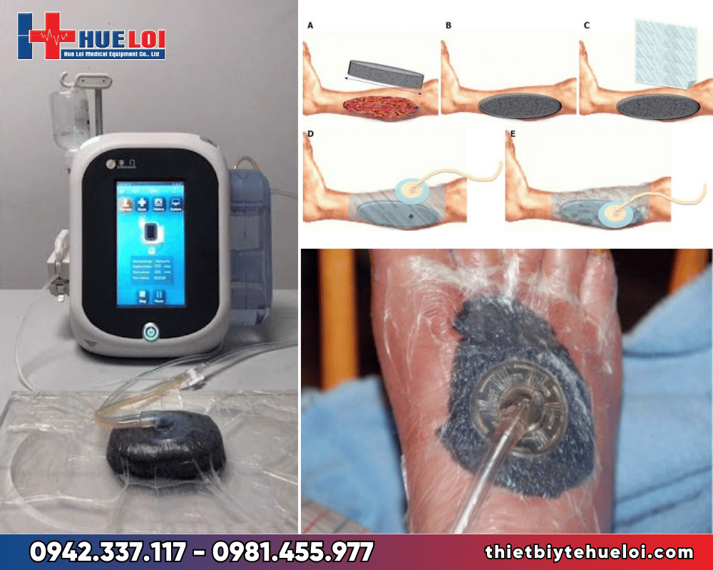 Máy điều trị vết loét do tiểu đường bằng phương pháp hút áp lực âm