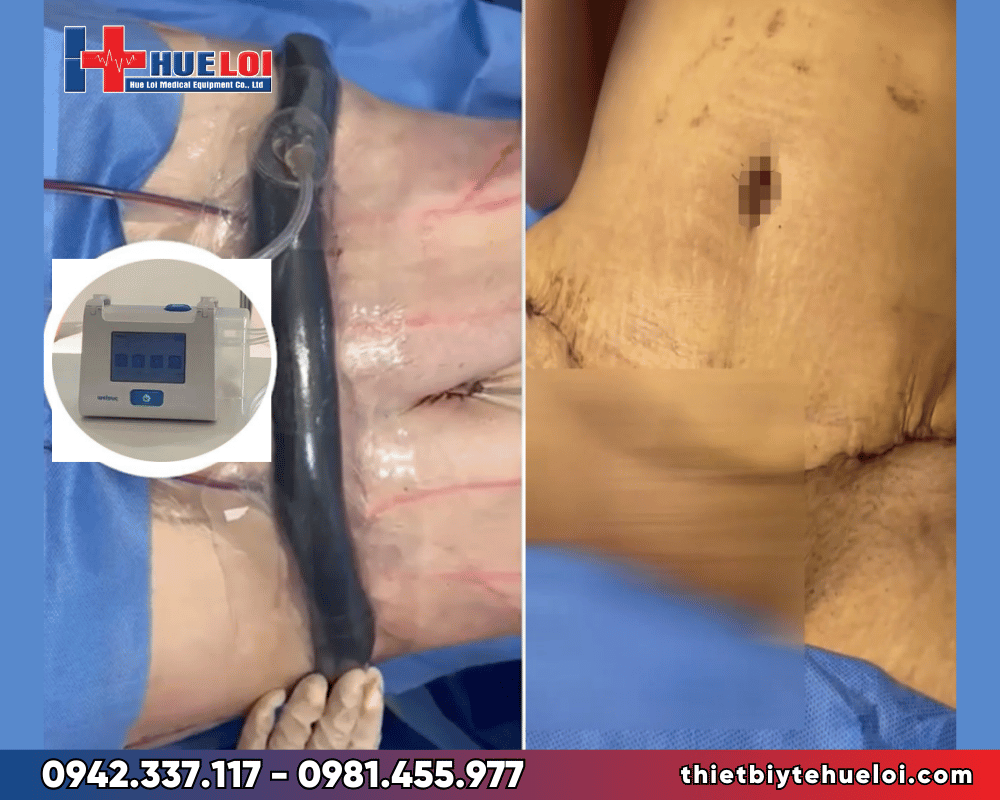 máy hút áp lực âm điều trị các vết thương lớn khó lành - RH-1000