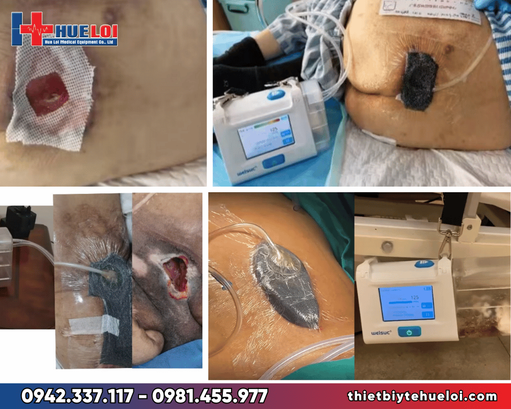 Phương pháp làm liền các vết thương hoại tử, vết loét khó lành bằng hút áp lực âm