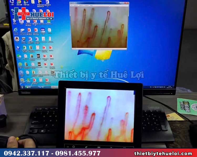 hình ảnh soi mạch máu với độ phóng đại 1200x